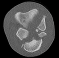 Radiograph of tarsal fractures
