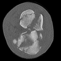 CT scan revealing comminution of tarsal fractures